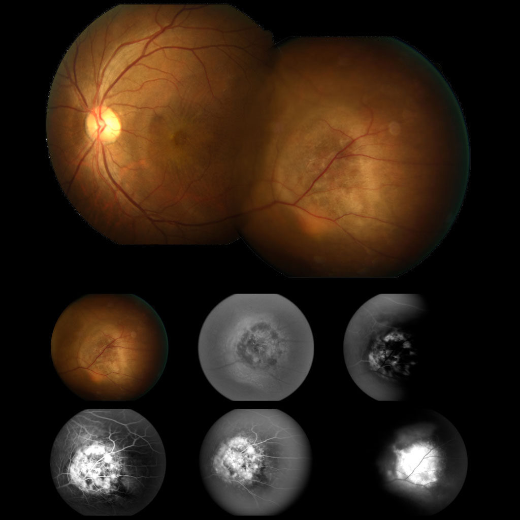 Tumores Intraoculares Oncovision